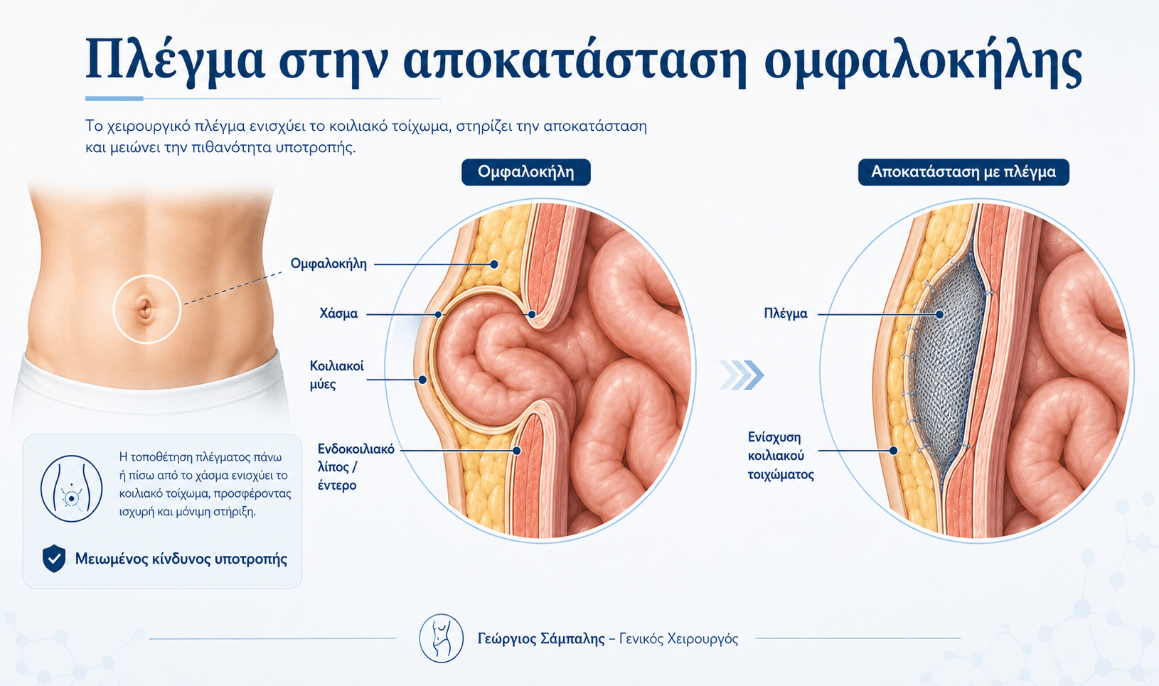 Πλέγμα στην χειρουργική αποκατάσταση ομφαλοκήλης