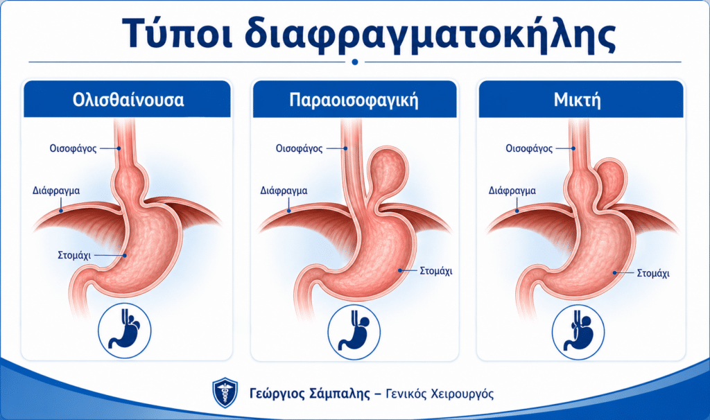 Τύποι διαφραγματοκήλης: ολισθαίνουσα, παραοισοφαγική και μικτή